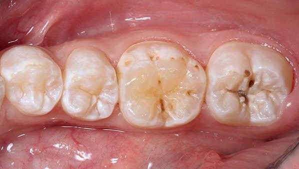 Кариес зубов: симптомы, причины, диагностика и лечение