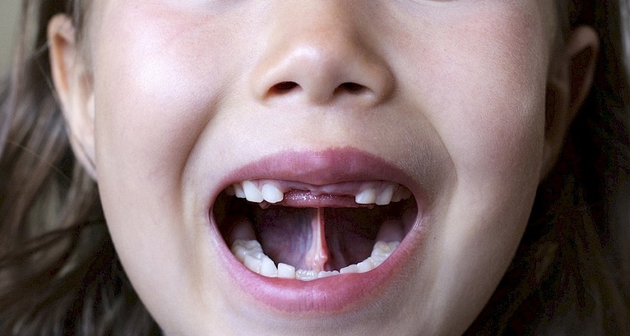 Короткая уздечка языка и верхней или нижней губы в стоматологии