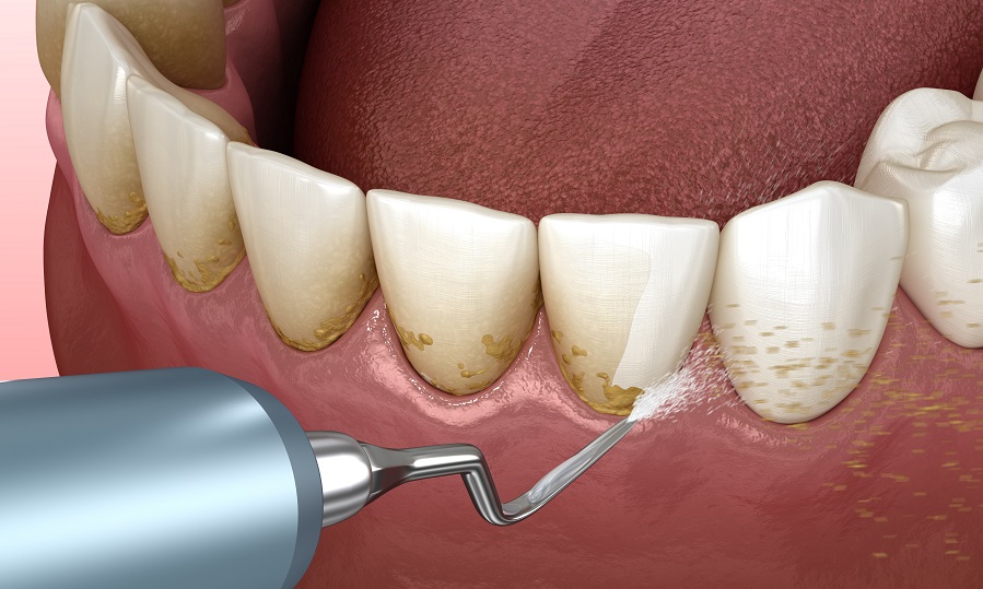 Зуб­ной ка­мень у детей: причины появления и удаление | Семейная стоматология