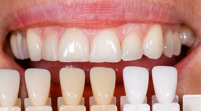 Композитные виниры Колибри стоматология