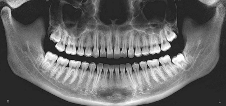 Панорамное фото зубов