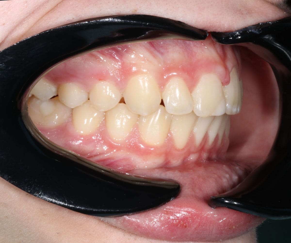 зубной ряд после брекетов
