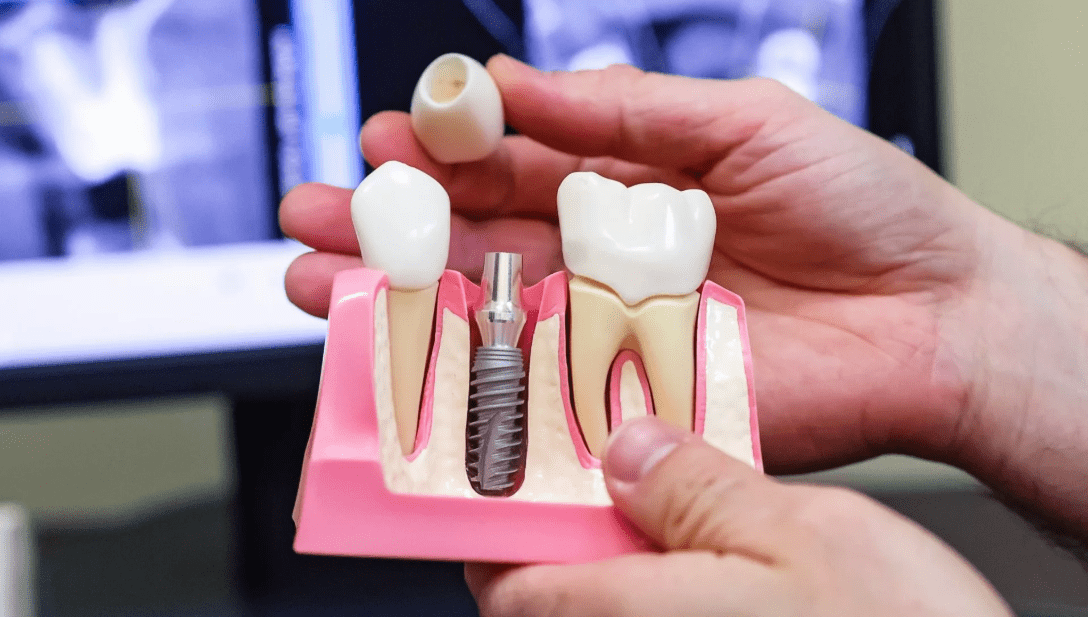 Протезирование на имплантатах – полноценная замена живому зубу