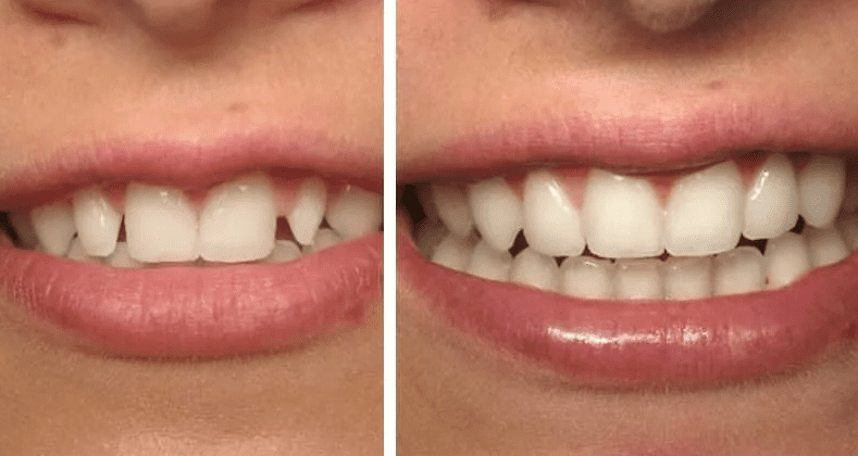 Наращивание зубов