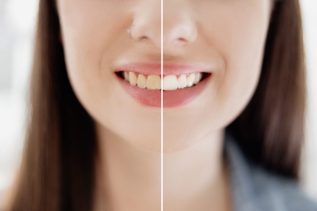 🚫❓Можно ли курить после отбеливания зубов? Ответы и рекомендации