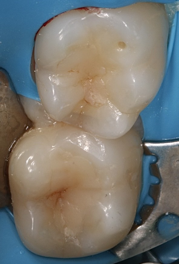 Результаты лечения зубов