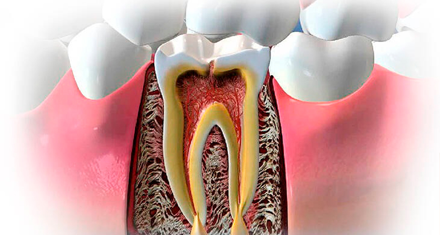 Температура после лечения зуба. Киста костной ткани зуба. Пародонтальный абсцесс зуба. Пародонтальная киста зуба.
