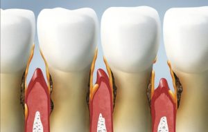 Киста зуба: как лечить