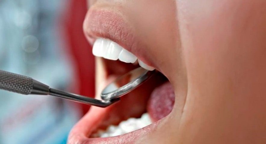 Что такое гингивит: откровенный рассказ стоматолога