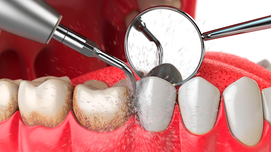 Зубной камень: как образуется, чем опасен и как его удалить