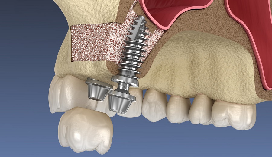Синус-лифтинг в стоматологии: что это за операция и кому нужна