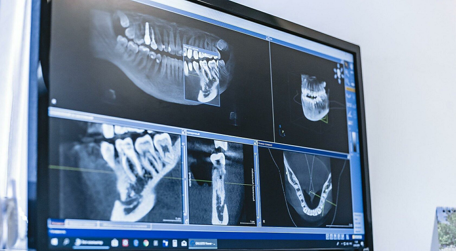 Дентальная компьютерная томография: что это за процедура и кому она необходима