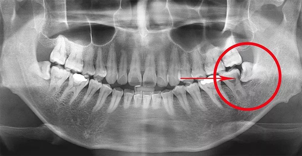 Как остановить кровотечение после удаления зуба?