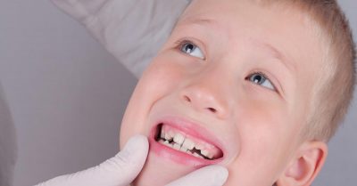 Зубы растут криво: как исправить ситуацию в детском возрасте
