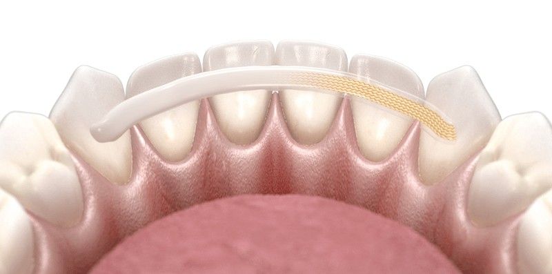 Шинирование зубов в стоматологии: кому и зачем необходима процедура